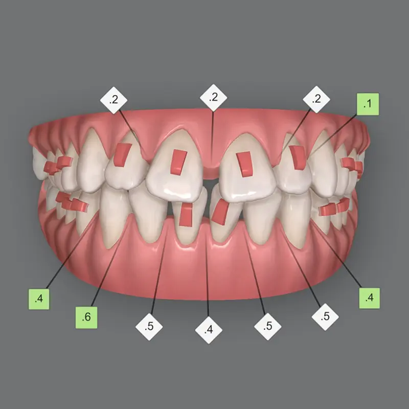 2 - Invisalign Clincheck