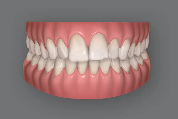 Invisalign Lite